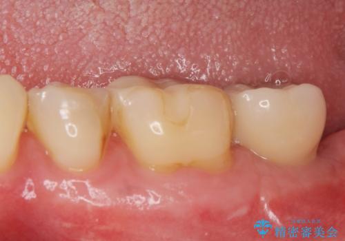 歯からの異臭　虫歯の再発からのインプラント治療の症例 治療後