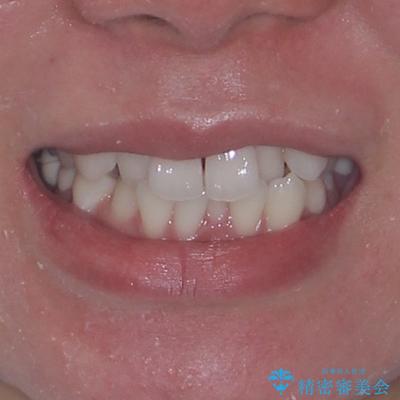 ワーキングホリデー前にきれいな歯列にの治療前(顔貌)