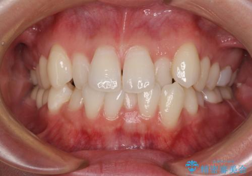 ワーキングホリデー前にきれいな歯列にの症例 治療前
