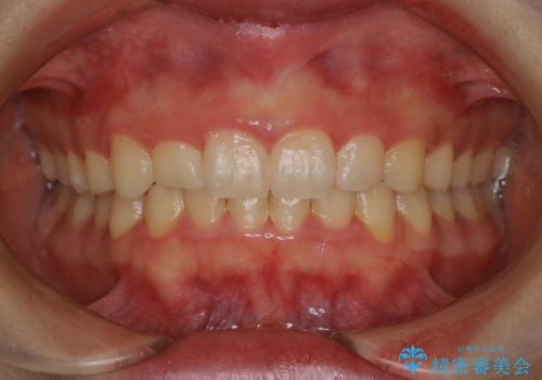 前歯のがたつきとディープバイト:インビザライン治療の症例 治療後