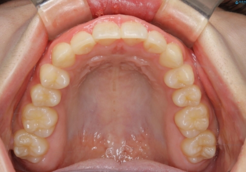 前歯のがたつきとディープバイト:インビザライン治療の治療後