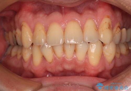 銀歯をなくしたい 全顎的なむし歯治療の症例 治療前