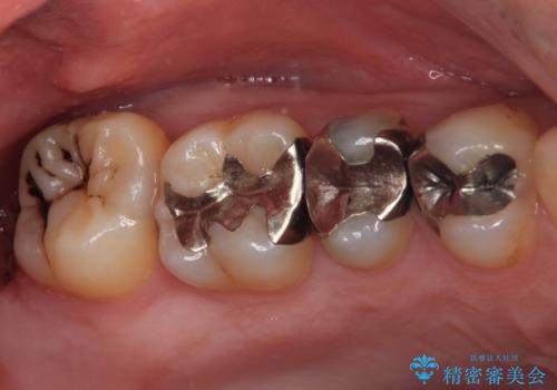銀歯をなくしたい 全顎的なむし歯治療の治療前