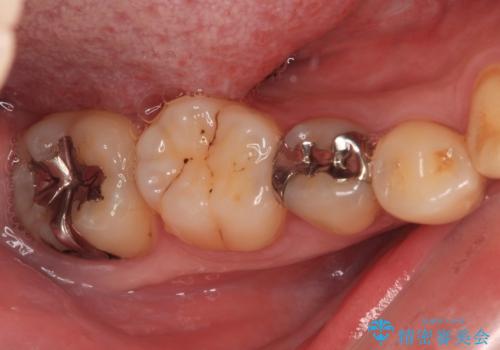 銀歯をなくしたい　全顎的なむし歯治療の治療前