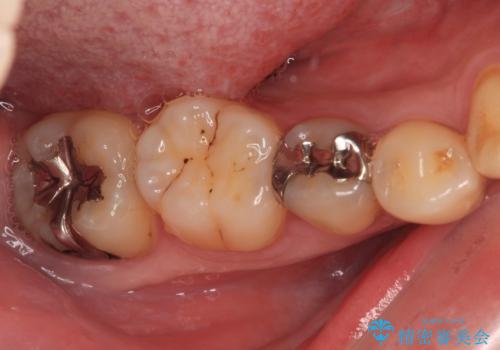 銀歯をなくしたい 全顎的なむし歯治療の治療前