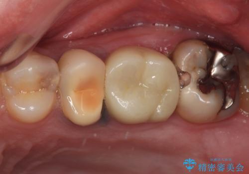 銀歯をなくしたい 全顎的なむし歯治療の治療前