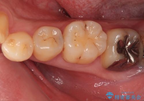 銀歯をなくしたい 全顎的なむし歯治療の治療前