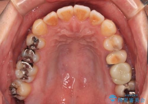 銀歯をなくしたい 全顎的なむし歯治療の治療前