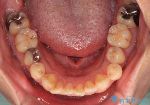 銀歯をなくしたい 全顎的なむし歯治療の治療前