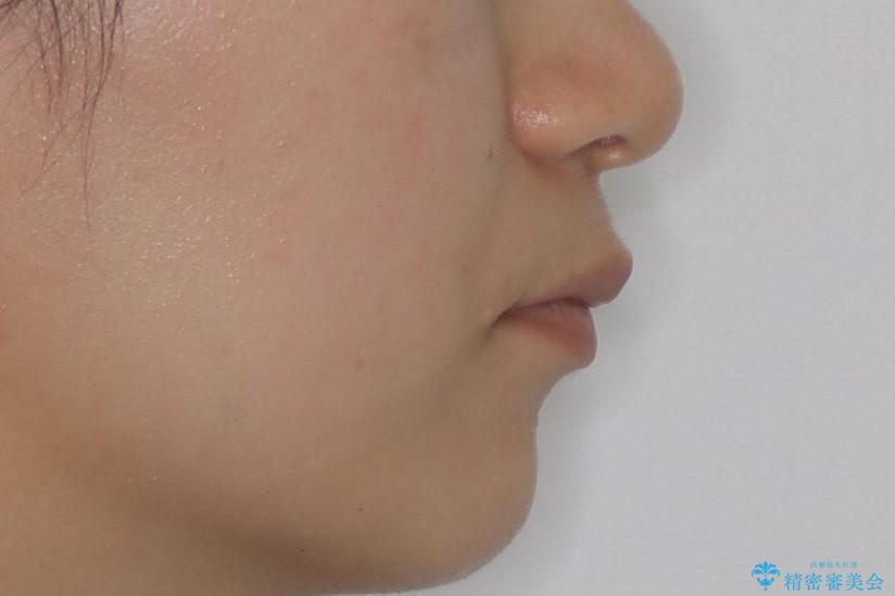 【インビザライン】前歯を下げたい。の治療前(顔貌)