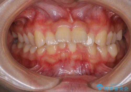 【インビザライン】前歯を下げたい。の治療前