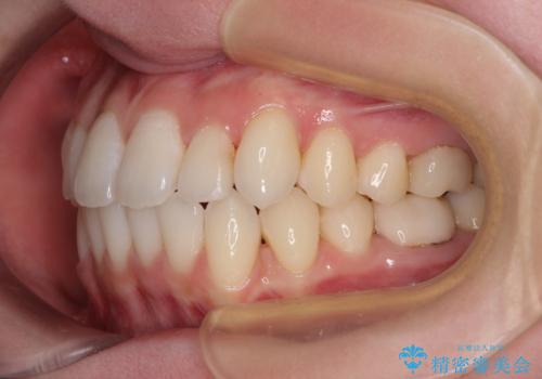 ワーキングホリデー前にきれいな歯列にの治療中