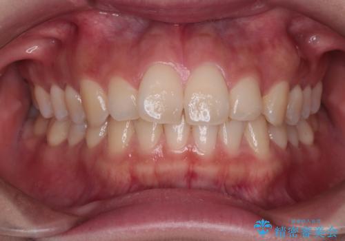 【インビザライン】前歯のでこぼこ。真ん中の位置を合わせたい。の症例 治療前