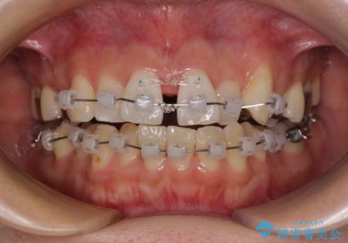 急速拡大装置 狭い歯列を拡大してワイヤー装置で短期間治療の治療中