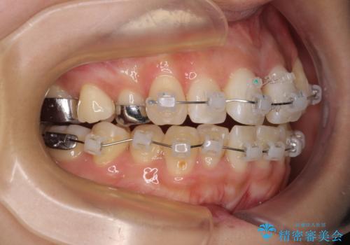 急速拡大装置　狭い歯列を拡大してワイヤー装置で短期間治療の治療中