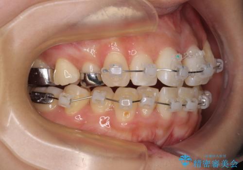 急速拡大装置 狭い歯列を拡大してワイヤー装置で短期間治療の治療中