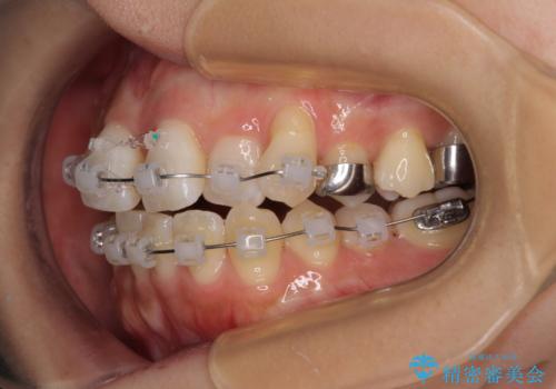 急速拡大装置 狭い歯列を拡大してワイヤー装置で短期間治療の治療中