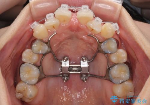急速拡大装置　狭い歯列を拡大してワイヤー装置で短期間治療の治療中