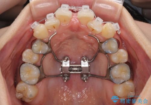急速拡大装置 狭い歯列を拡大してワイヤー装置で短期間治療の治療中