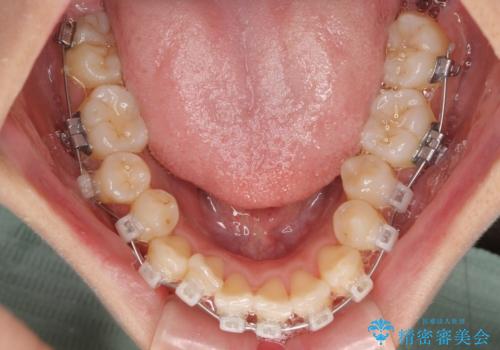 急速拡大装置 狭い歯列を拡大してワイヤー装置で短期間治療の治療中