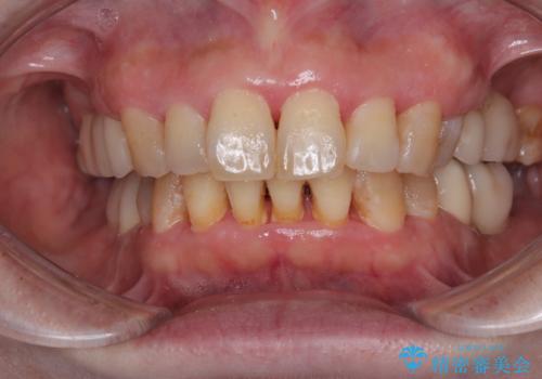 治療中で放置 インプラントでしっかりと咬めるようにの治療後