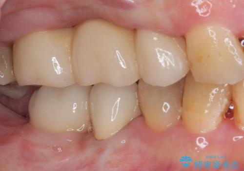 治療中で放置 インプラントでしっかりと咬めるようにの治療後