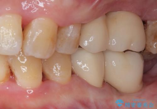 治療中で放置　インプラントでしっかりと咬めるようにの治療後