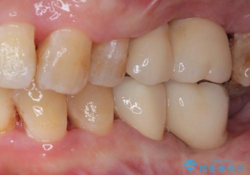 治療中で放置 インプラントでしっかりと咬めるようにの治療後