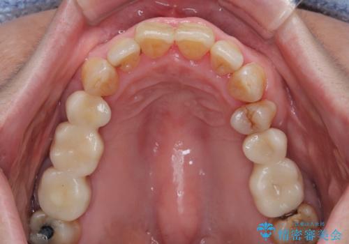 治療中で放置 インプラントでしっかりと咬めるようにの治療後