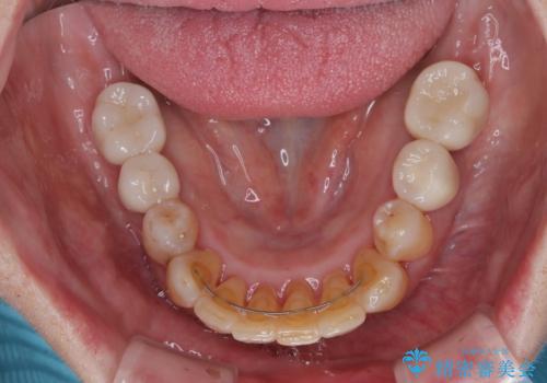 治療中で放置 インプラントでしっかりと咬めるようにの治療後