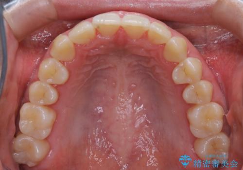 【非抜歯】インビザラインで正しい噛み合わせをの治療後