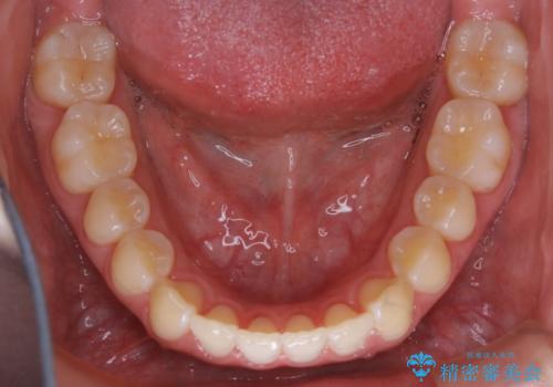 【非抜歯】インビザラインで正しい噛み合わせをの治療後