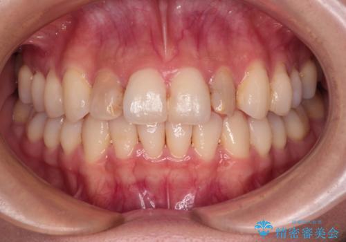 前歯をきれいにしたい オールセラミッククラウンにによる補綴の症例 治療前