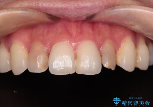 前歯をきれいにしたい オールセラミッククラウンにによる補綴の治療前