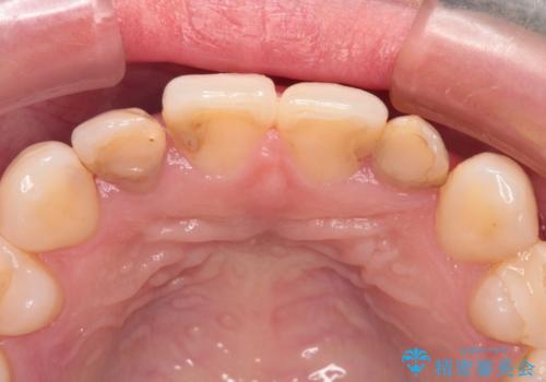 前歯をきれいにしたい オールセラミッククラウンにによる補綴の治療前