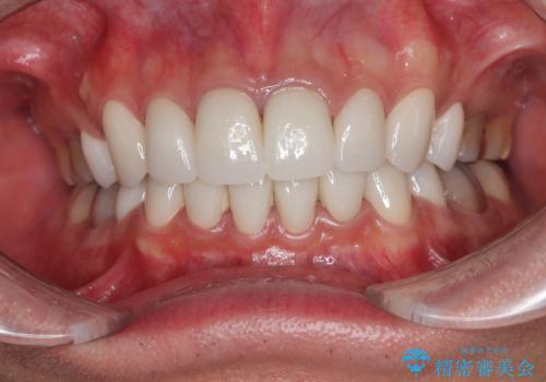 薬剤の影響で変色した歯を自然に オールセラミッククラウンによる審美歯科治療の治療後