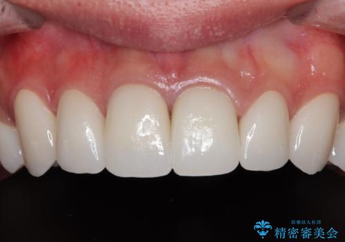 薬剤の影響で変色した歯を自然に オールセラミッククラウンによる審美歯科治療の症例 治療後