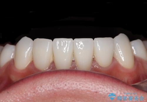 薬剤の影響で変色した歯を自然に オールセラミッククラウンによる審美歯科治療の治療後