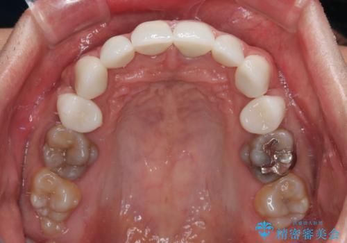 薬剤の影響で変色した歯を自然に オールセラミッククラウンによる審美歯科治療の治療後