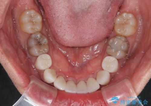 薬剤の影響で変色した歯を自然に オールセラミッククラウンによる審美歯科治療の治療後