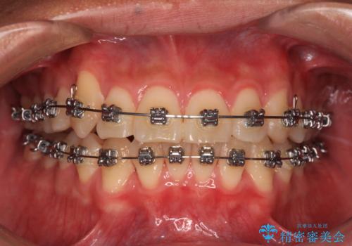八重歯を無理なくなおしたい ワイヤー装置による非抜歯矯正治療の治療中