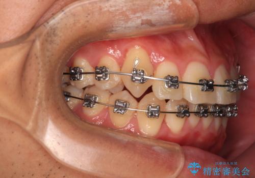 八重歯を無理なくなおしたい ワイヤー装置による非抜歯矯正治療の治療中