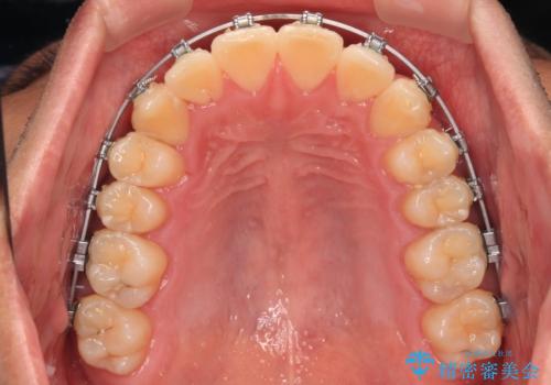 八重歯を無理なくなおしたい　ワイヤー装置による非抜歯矯正治療の治療中