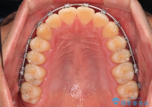 八重歯を無理なくなおしたい ワイヤー装置による非抜歯矯正治療の治療中