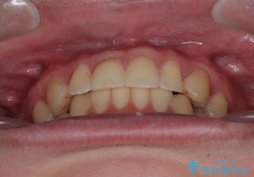 上下のデコボコを治したい インビザラインによる矯正治療の治療後