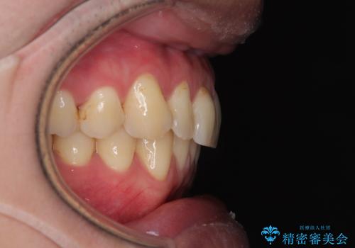 上下のデコボコを治したい インビザラインによる矯正治療の治療後