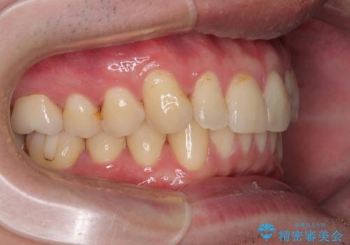 上下のデコボコを治したい インビザラインによる矯正治療の治療後
