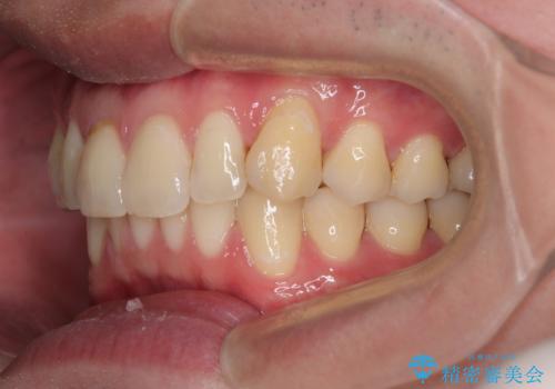 上下のデコボコを治したい インビザラインによる矯正治療の治療後