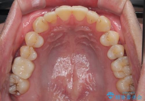 上下のデコボコを治したい インビザラインによる矯正治療の治療後