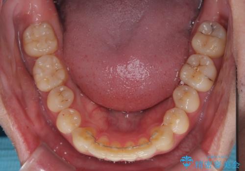 上下のデコボコを治したい インビザラインによる矯正治療の治療後